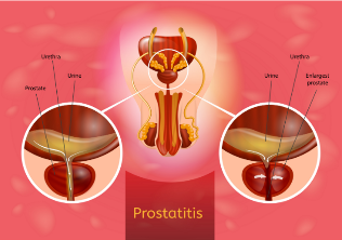 prostate inflammation
