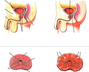 normal prostate gland inflammation and chronic prostatitis
