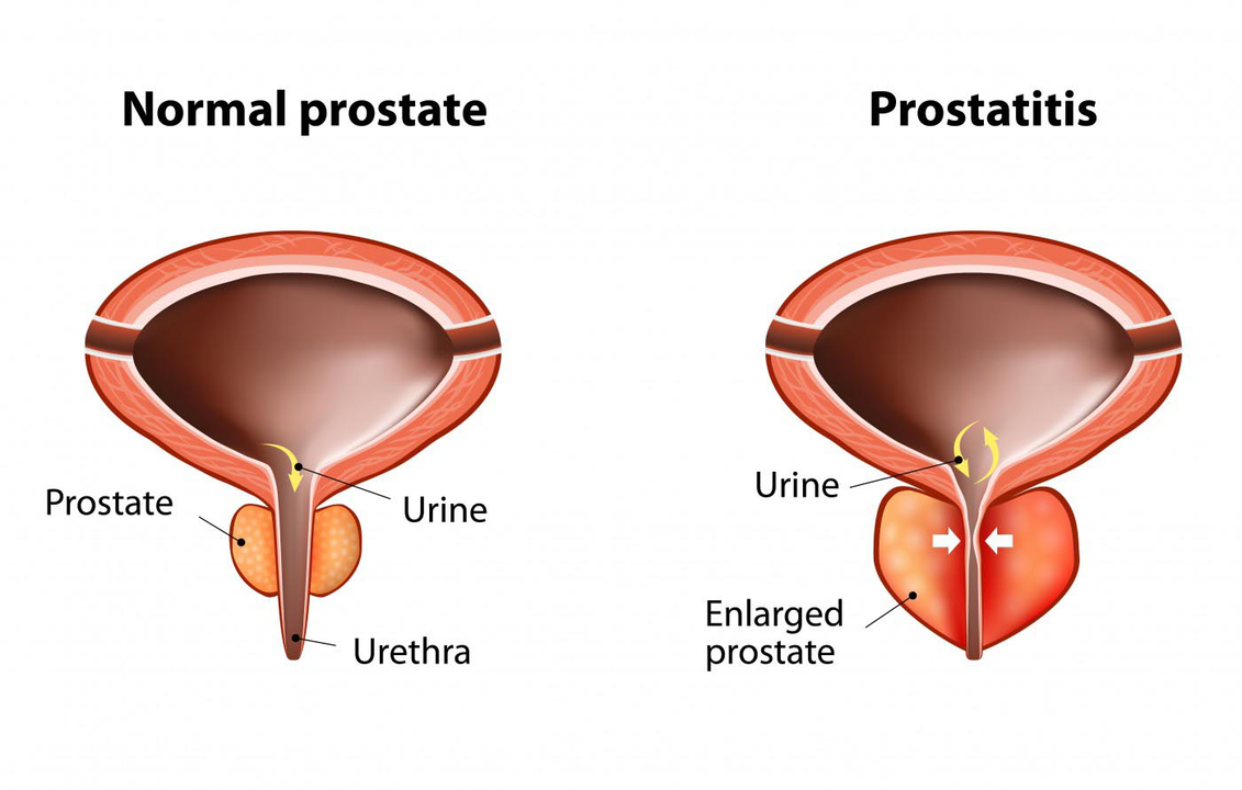 Normal prostate of a healthy man and prostatitis with prostatitis